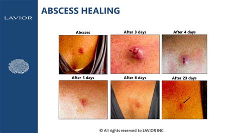 Usually the vicinity to the anal canal causes painful defecation. . Perianal abscess healing stages pictures
